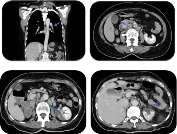 Severe Mitral Regurgitation-Induced Acute Heart Failure due to Nonbacterial Thrombotic Endocarditis in a Patient With Urothelial Carcinoma Recurrence.