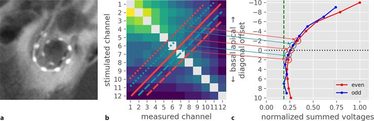 Voltage Matrix Algorithm for Intraoperative Detection of Cochlear Implant Electrode Misplacement.