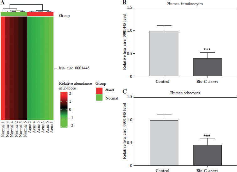 Hsa_circ_0001445 regulates acne inflammation <i>via</i> sponging miR-1298-5p targeting ESR1.