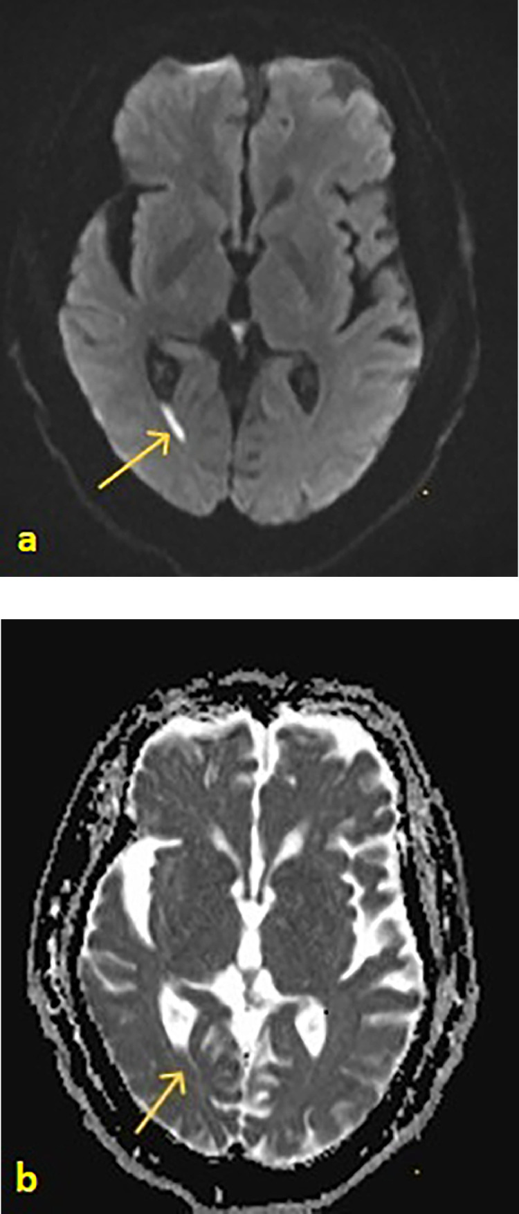 Cerebrospinal fluid leak-associated ventriculitis - a case report.