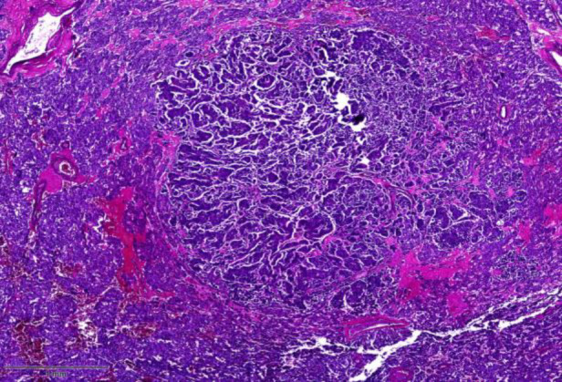 Tumor-to-Tumor Metastasis: An Uncommon Case of Metastatic Breast Carcinoma to Pheochromocytoma.