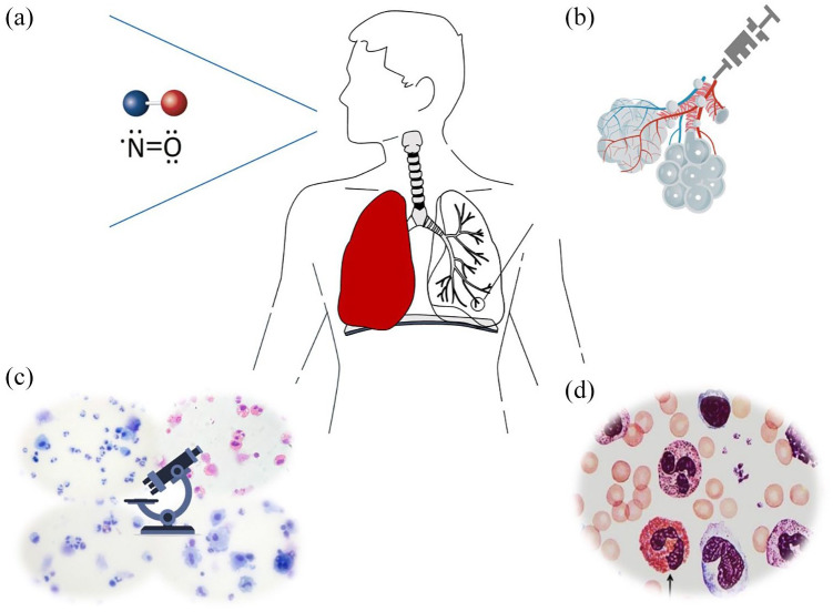 Eosinophils in chronic obstructive pulmonary disease.