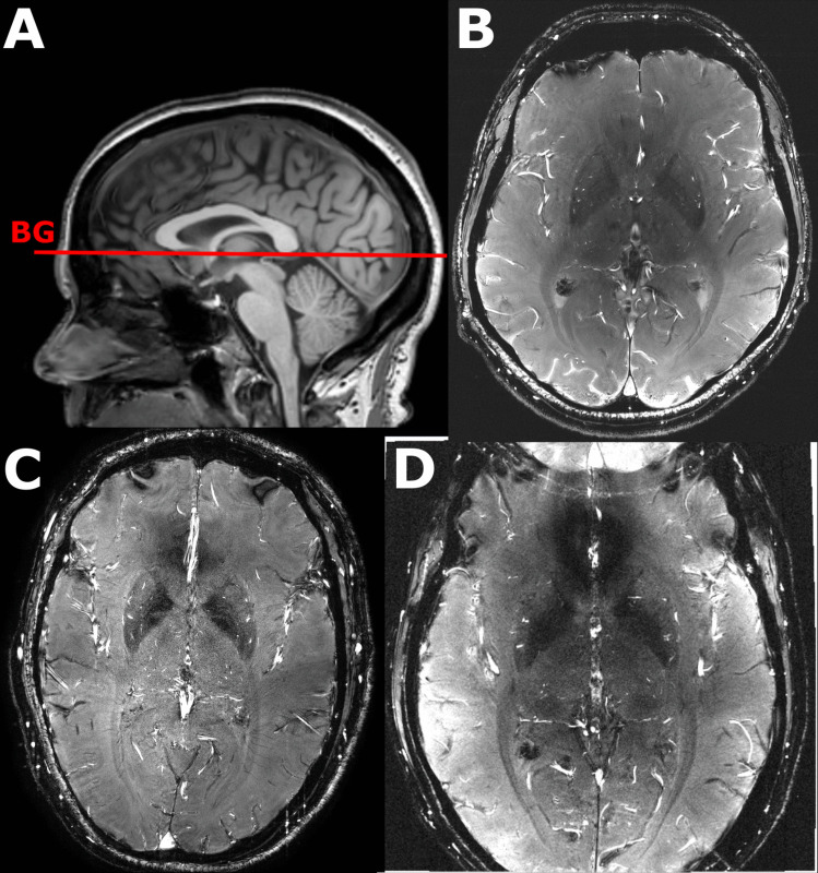 Blood Flow Velocity Analysis in Cerebral Perforating Arteries on 7T 2D Phase Contrast MRI with an Open-Source Software Tool (SELMA).
