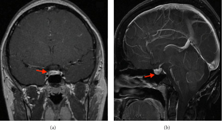 Microprolactinoma Growth During Pregnancy With Pituitary Tumor Apoplexy: Case Report and Review of the Literature.