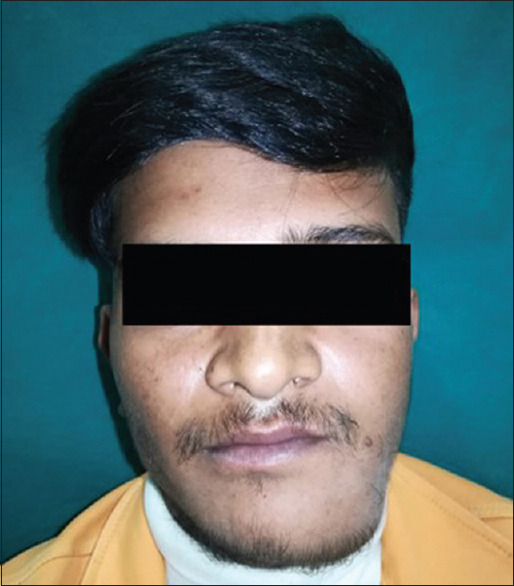 Anomalous Jaw Tumour Progression from Multiple Complex Odontomas to Cemento-ossifying Fibroma - A Case Report.