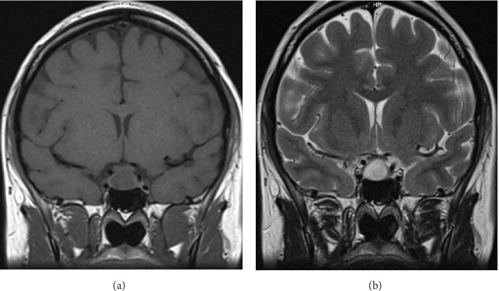 Microprolactinoma Growth During Pregnancy With Pituitary Tumor Apoplexy: Case Report and Review of the Literature.