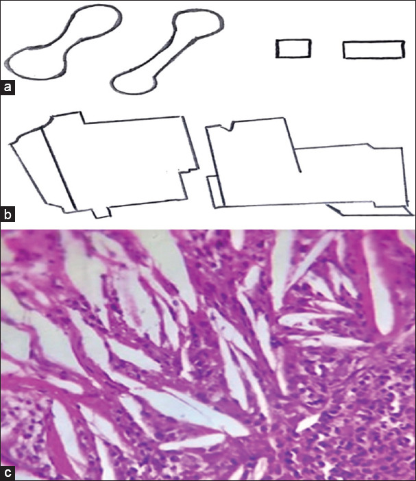 Crystals and crystalloids in oral pathology - An overview.