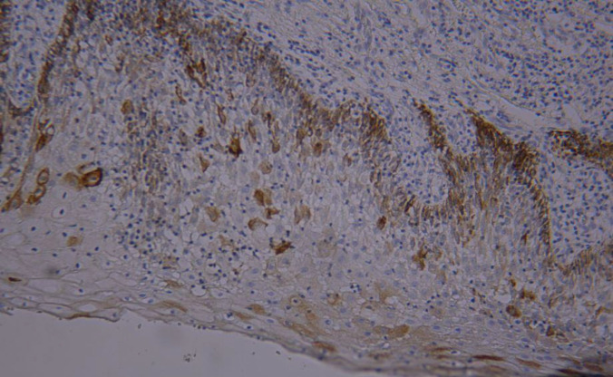 Evaluation of Cytokeratin 19 Expression in Oral Carcinogenesis.