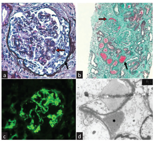 Oral Anticoagulant-Related Nephropathy: A New Cause for an Old Entity.