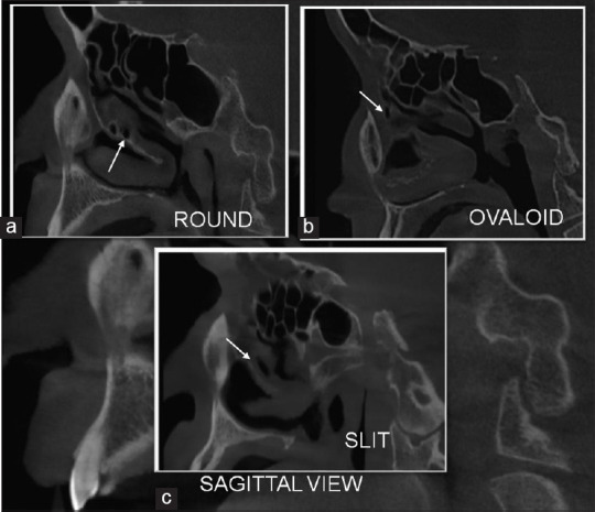 Prevalence of Accessory Maxillary Sinus Ostia and its Distribution with Gender and Subtypes - A Retrospective Study.