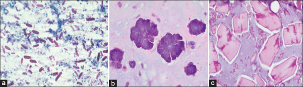 Crystals and crystalloids in oral pathology - An overview.