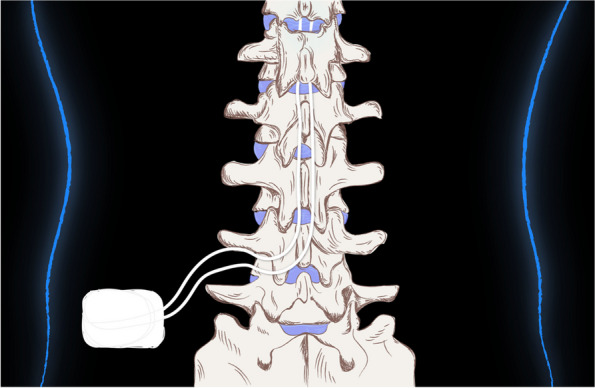 Neuromodulation in chronic pain management: addressing persistent doubts in spinal cord stimulation.