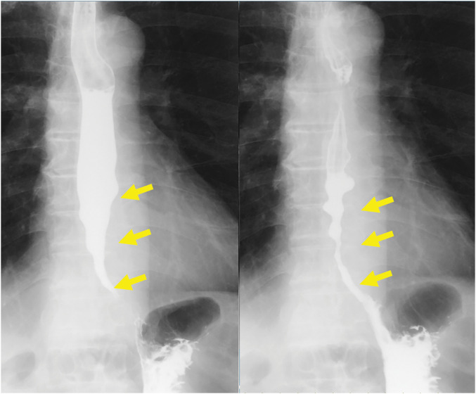 Jejunal Interposition with Overlap Esophago-Jejunal Anastomosis for an Esophageal Stricture due to Repeated Endoscopic Dilation for Esophageal Achalasia: A Case Report.