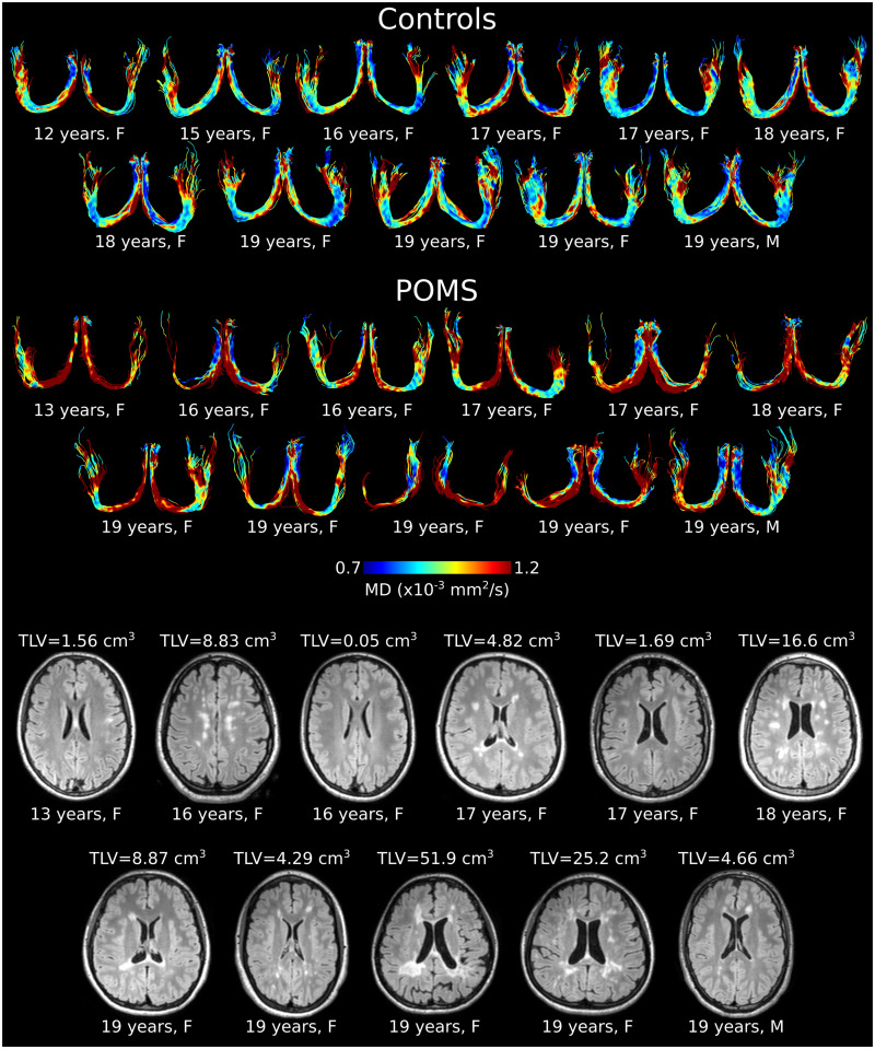Disproportional smaller fornix with altered microstructure in pediatric multiple sclerosis shown by high-resolution fluid-suppressed diffusion tractography.