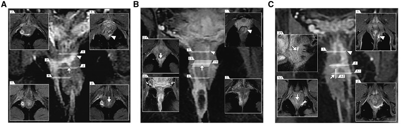 Preliminary results of a novel sphincter-sparing technique-fistula occlusion with the internal sphincter flap (FOISF)-for high complex anal fistulas.