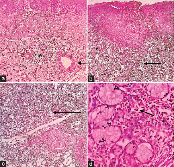 Idiopathic sialadenosis mimicking neoplasms: Clinical and histopathological considerations.