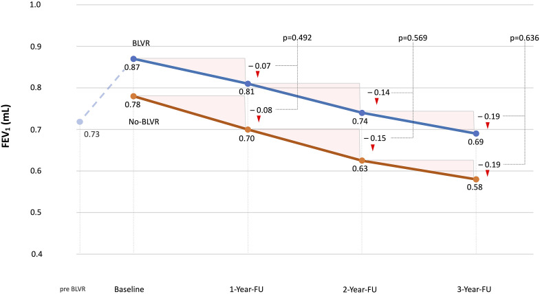 Comparative analysis of pulmonary function decline in patients undergoing bronchoscopic lung volume reduction with endobronchial valves versus conservative treatment in emphysema management: A longitudinal coarsened exact matched analysis.