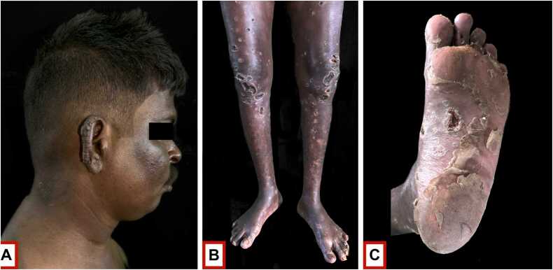 Necrotic erythema nodosum leprosum – A case of severe lepromatous reaction in a multibacillary leprosy patient