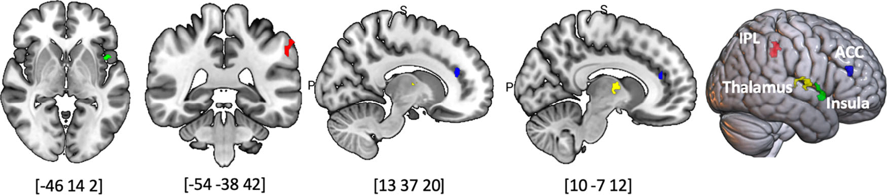 Single-dose psilocybin alters resting state functional networks in patients with body dysmorphic disorder.