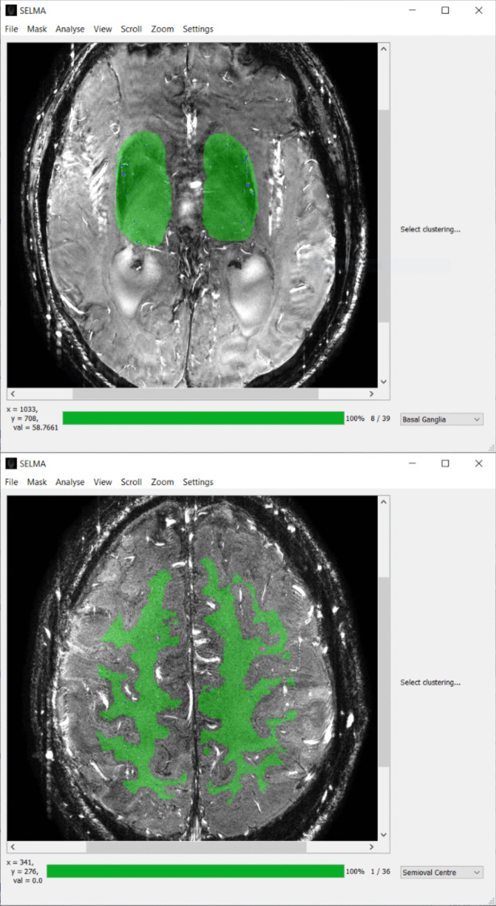 Blood Flow Velocity Analysis in Cerebral Perforating Arteries on 7T 2D Phase Contrast MRI with an Open-Source Software Tool (SELMA).