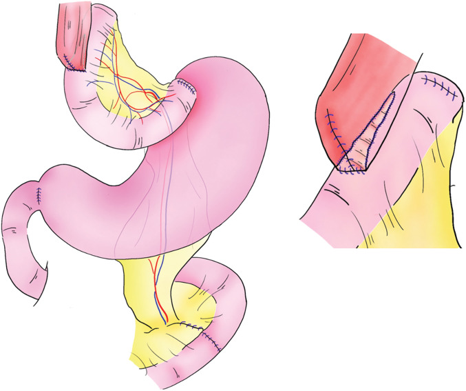 Jejunal Interposition with Overlap Esophago-Jejunal Anastomosis for an Esophageal Stricture due to Repeated Endoscopic Dilation for Esophageal Achalasia: A Case Report.