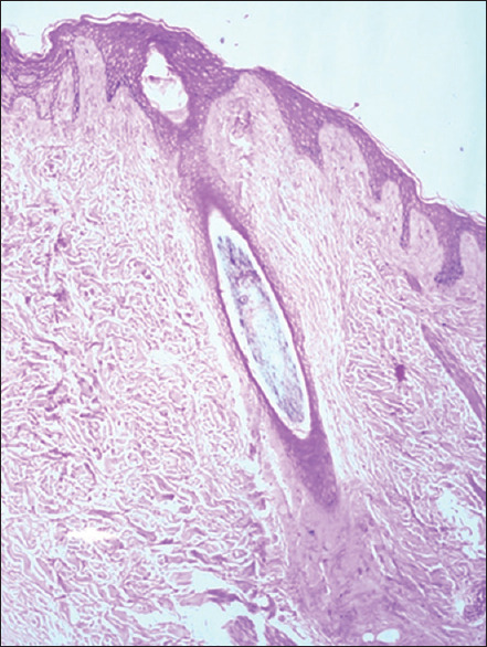 Trichopathology of Cicatricial Alopecia.