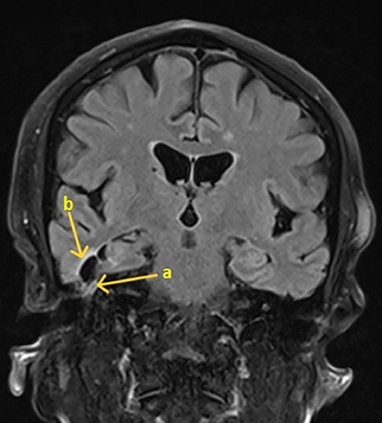 Cerebrospinal fluid leak-associated ventriculitis - a case report.