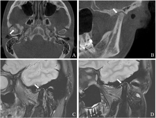 "Bouncing temporomandibular joint": Multiple temporomandibular lesions in a patient with rheumatoid arthritis.