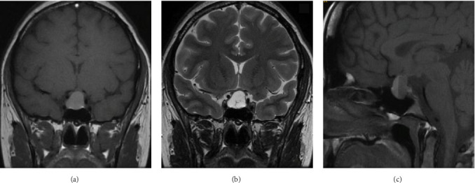 Microprolactinoma Growth During Pregnancy With Pituitary Tumor Apoplexy: Case Report and Review of the Literature.