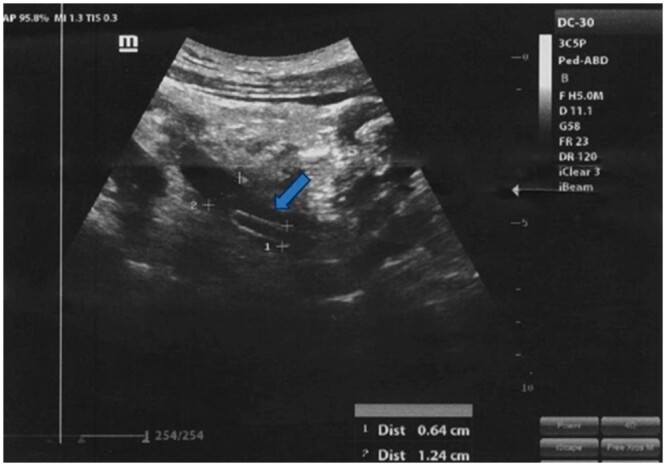 Unusual presentation of <i>Ascaris lumbricoides</i> in the urinary tract: a case report.