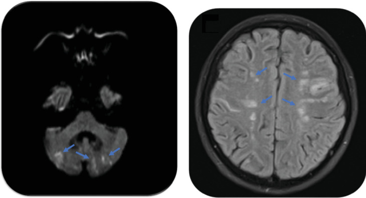 Severe Mitral Regurgitation-Induced Acute Heart Failure due to Nonbacterial Thrombotic Endocarditis in a Patient With Urothelial Carcinoma Recurrence.
