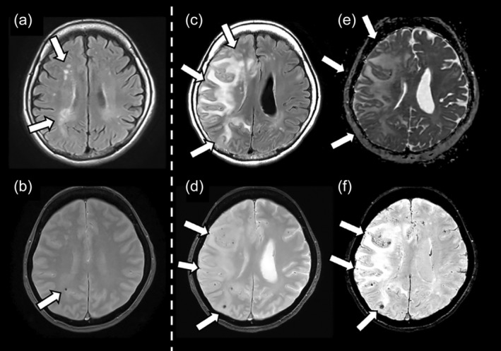 A case of severe ARIA with multiple infarctions and extensive microbleeds following lecanemab administration.