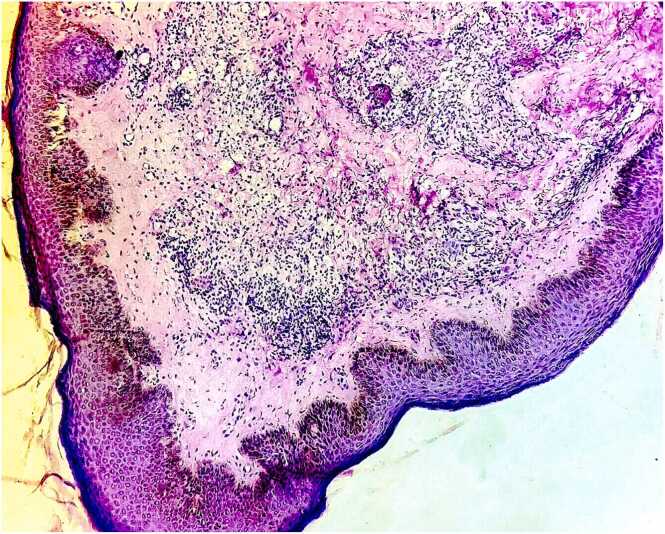 Necrotic erythema nodosum leprosum – A case of severe lepromatous reaction in a multibacillary leprosy patient
