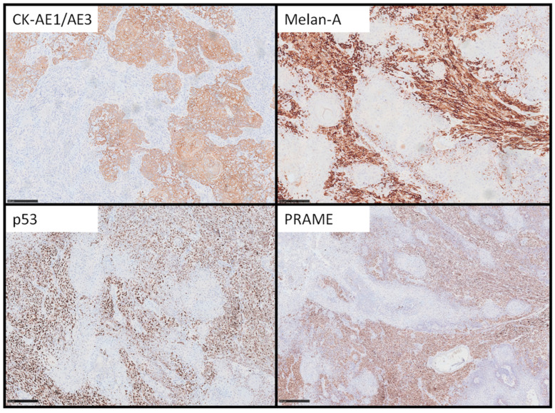 Squamomelanocytic Tumor, An Entity Still Shrouded in Mystery: Case Report and Literature Review.