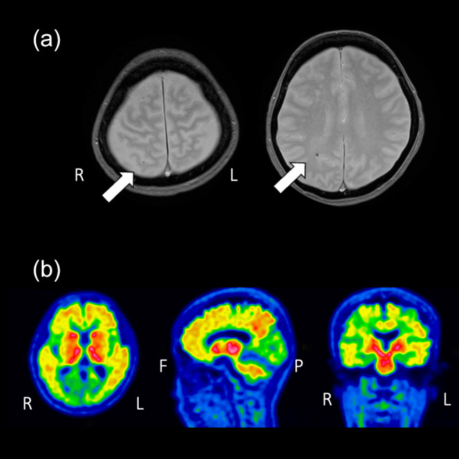 A case of severe ARIA with multiple infarctions and extensive microbleeds following lecanemab administration.