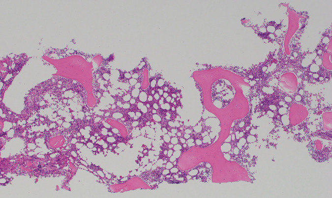 A Case Report of Severe Thrombocytopenic Purpura during Neoadjuvant Pembrolizumab Administration for Triple-Negative Breast Cancer.