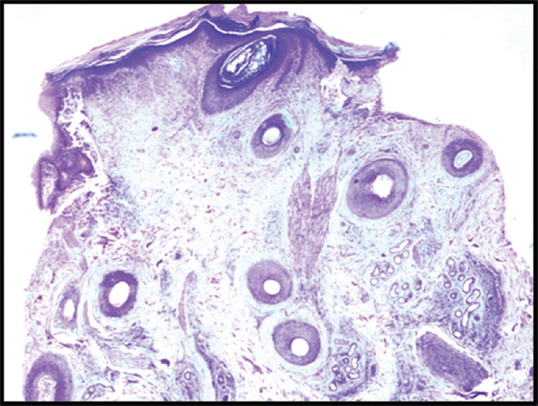 Trichopathology of Cicatricial Alopecia.