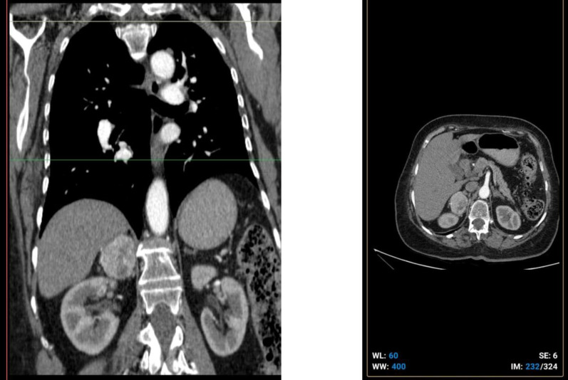 Tumor-to-Tumor Metastasis: An Uncommon Case of Metastatic Breast Carcinoma to Pheochromocytoma.