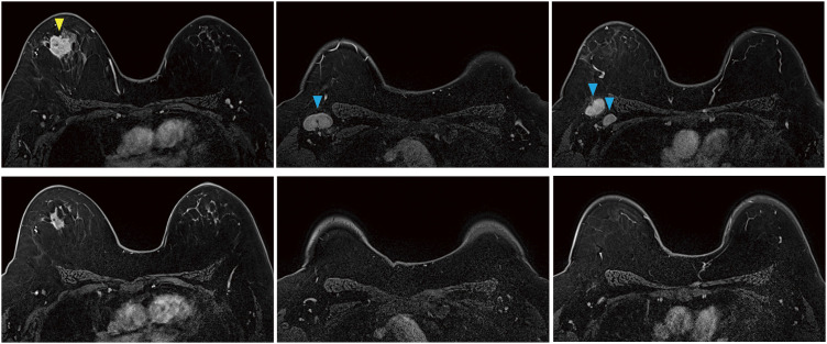 A Case Report of Severe Thrombocytopenic Purpura during Neoadjuvant Pembrolizumab Administration for Triple-Negative Breast Cancer.