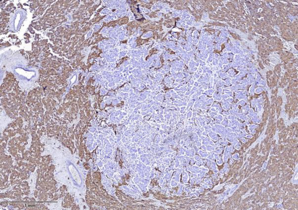Tumor-to-Tumor Metastasis: An Uncommon Case of Metastatic Breast Carcinoma to Pheochromocytoma.