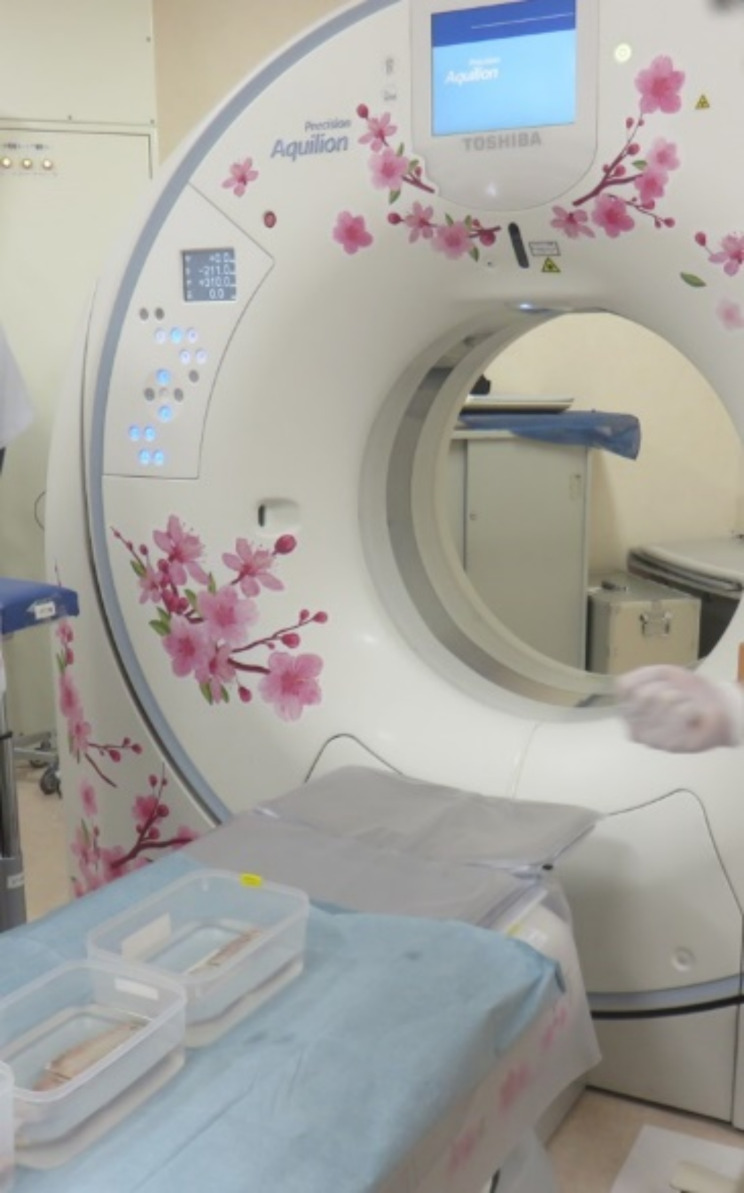 Usefulness of a novel density measurement drill for evaluating cancellous bone density: correlation between CT value and drilling torque value in bovine ribs.