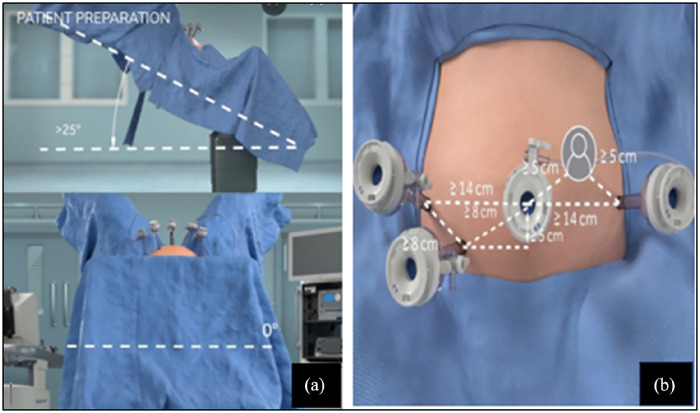Robotics-assisted surgery in gynecology: A single-center experience with the Hugo™ RAS system in India.