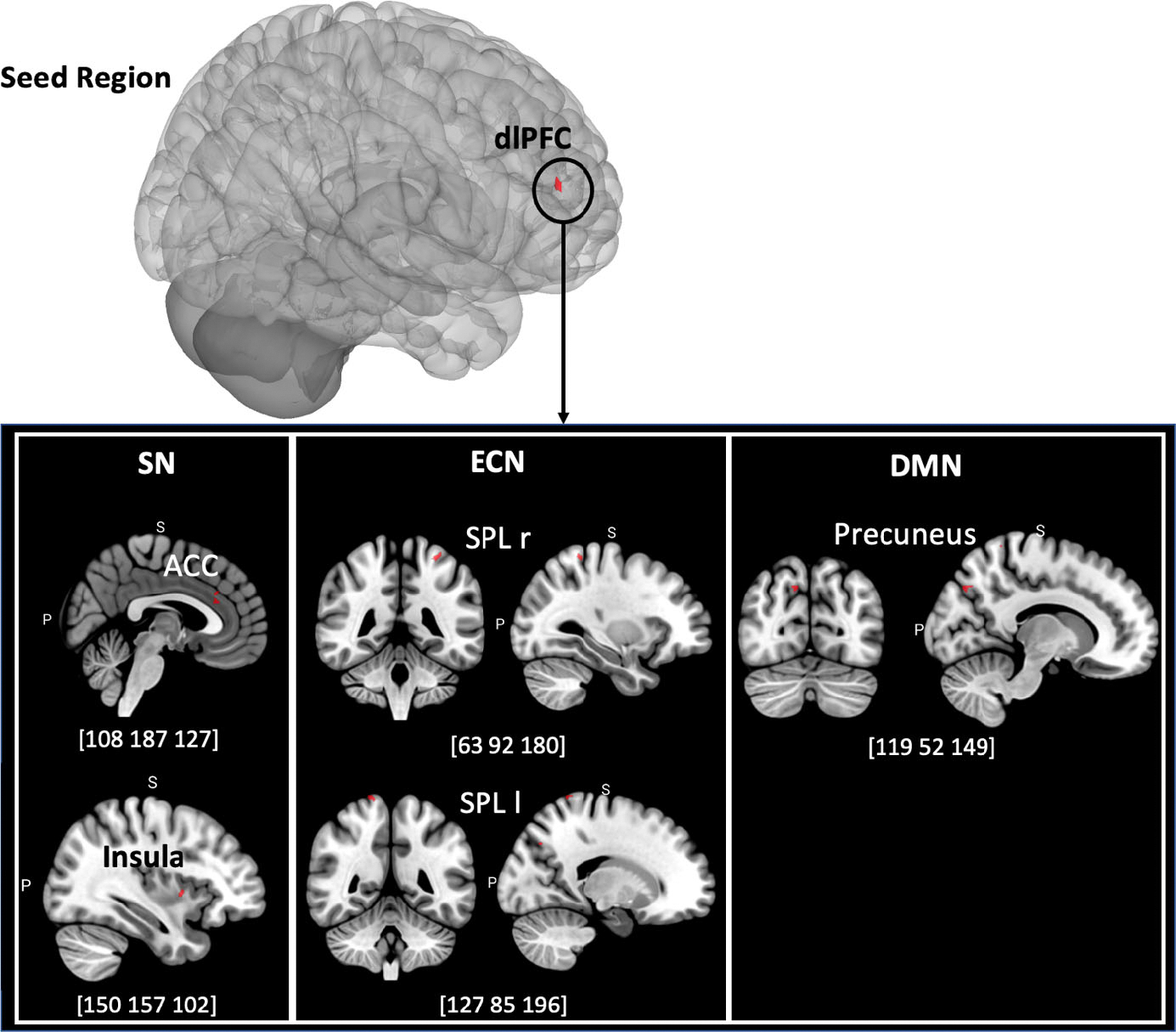 Single-dose psilocybin alters resting state functional networks in patients with body dysmorphic disorder.