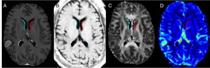 Advanced imaging reveals enhanced malignancy in glioblastomas involving the subventricular zone: evidence of increased infiltrative growth and perfusion.