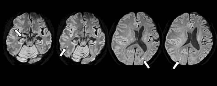 A case of severe ARIA with multiple infarctions and extensive microbleeds following lecanemab administration.