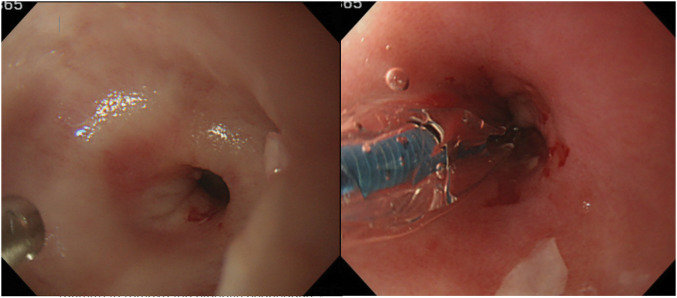 Jejunal Interposition with Overlap Esophago-Jejunal Anastomosis for an Esophageal Stricture due to Repeated Endoscopic Dilation for Esophageal Achalasia: A Case Report.