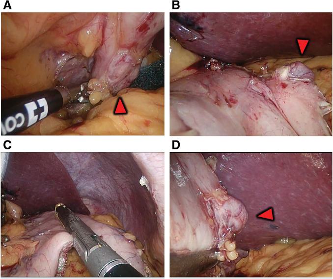 Obese Patient with Gastric Diverticulum Undergoing Laparoscopic Sleeve Gastrectomy Guided by Preoperative Endoscopic Measurement: A Case Report and Literature Review.