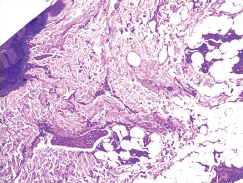 Trichopathology of Cicatricial Alopecia.