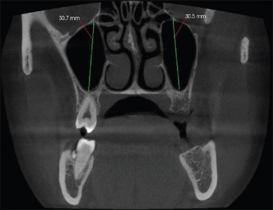 Prevalence of Accessory Maxillary Sinus Ostia and its Distribution with Gender and Subtypes - A Retrospective Study.