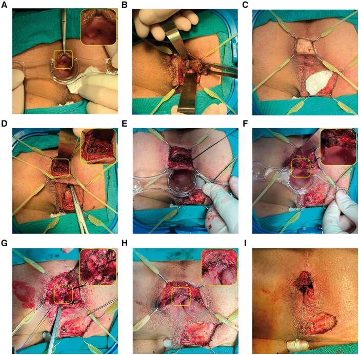 Preliminary results of a novel sphincter-sparing technique-fistula occlusion with the internal sphincter flap (FOISF)-for high complex anal fistulas.